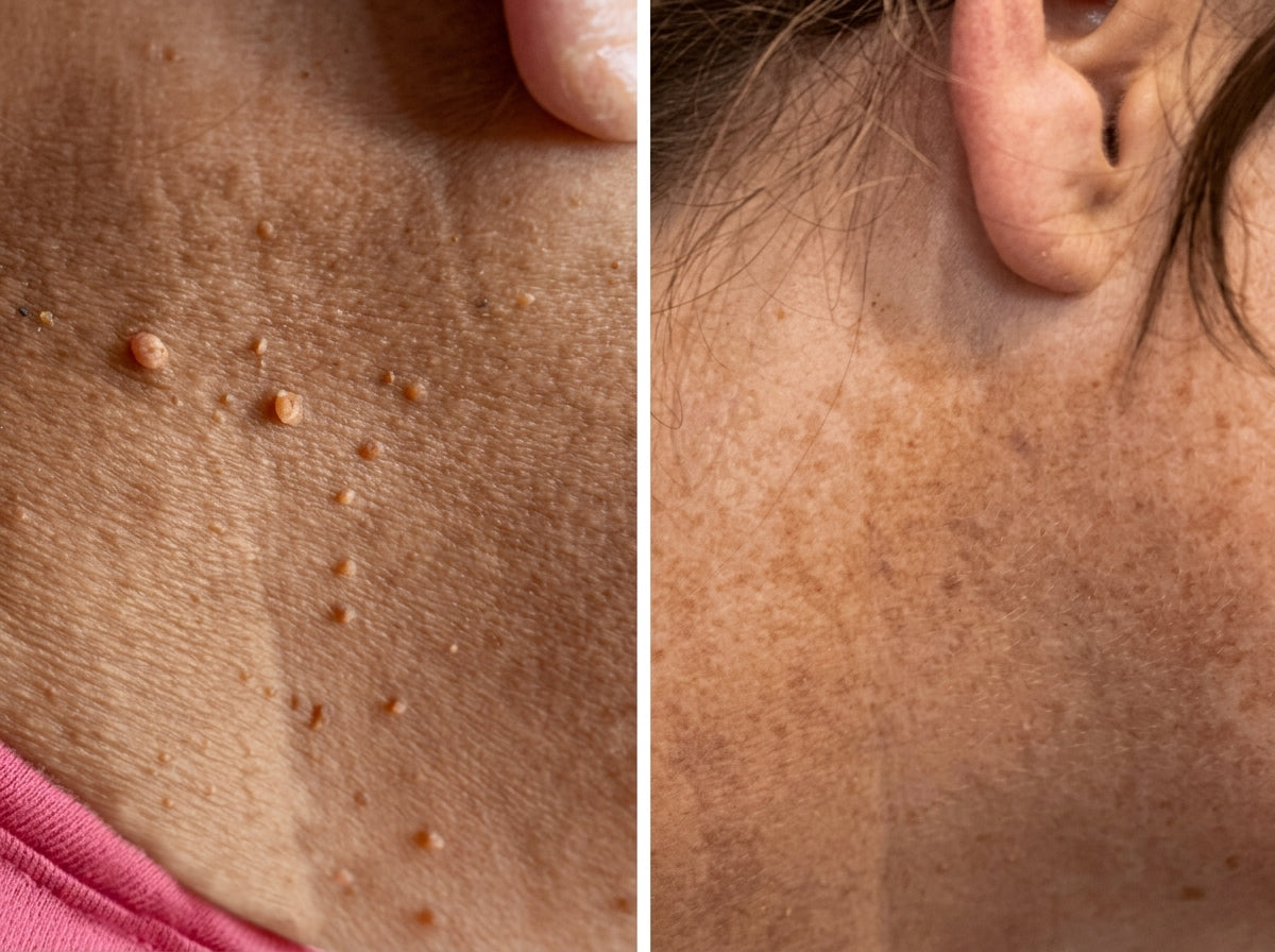 EaseWelly SkinEaseβ’ | Skin Tag Removal Kit