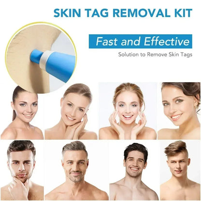 Painless Skin Tag Removal Kit