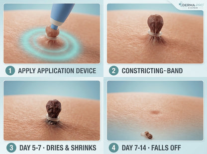 EaseWelly SkinEase™ | Skin Tag Removal Kit