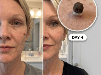 EaseWelly SkinEase™ | Skin Tag Removal Kit